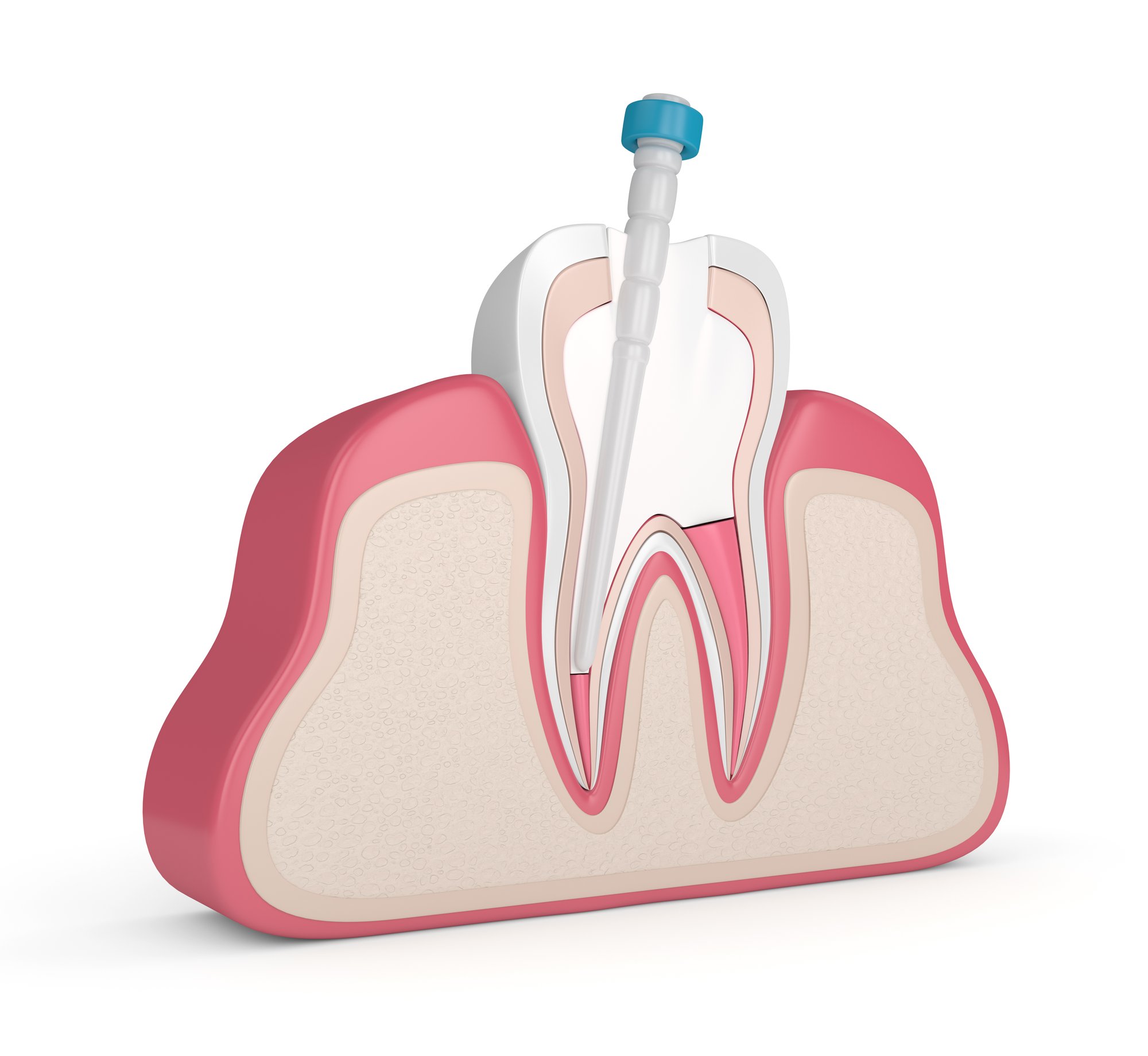 Can You Get a Root Canal in a Single Visit?